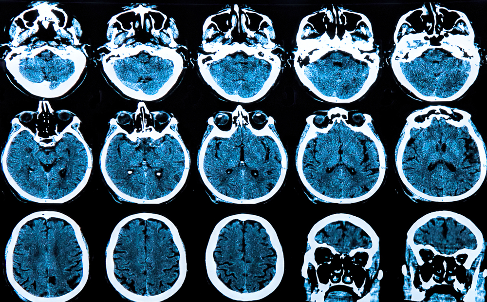 Multiple cross-sectional CT scan images of a human brain arranged in a grid, showing horizontal and coronal views in blue and white tones for diagnostic analysis.