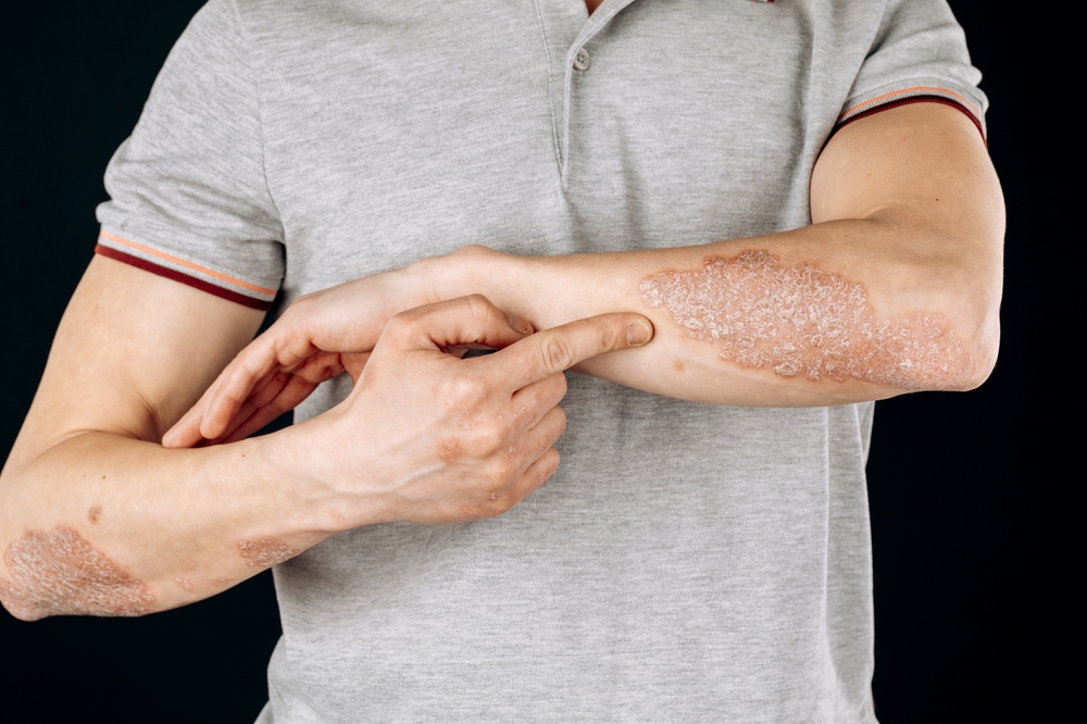 Man wearing a grey polo shirt pointing to a large patch of psoriasis on his forearm, with additional visible psoriasis plaques on his other arm. The skin appears dry, red, and scaly.