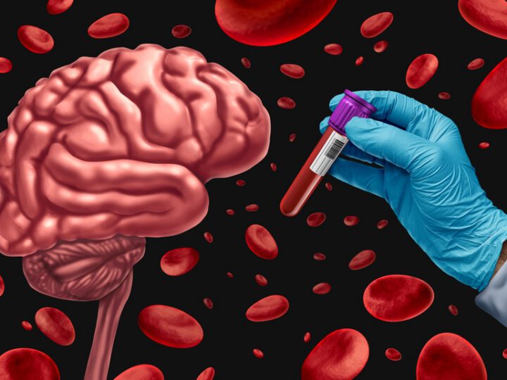 Fujirebio’s FDA-Approved Alzheimer’s Blood Test Hailed as ‘Game Changer’