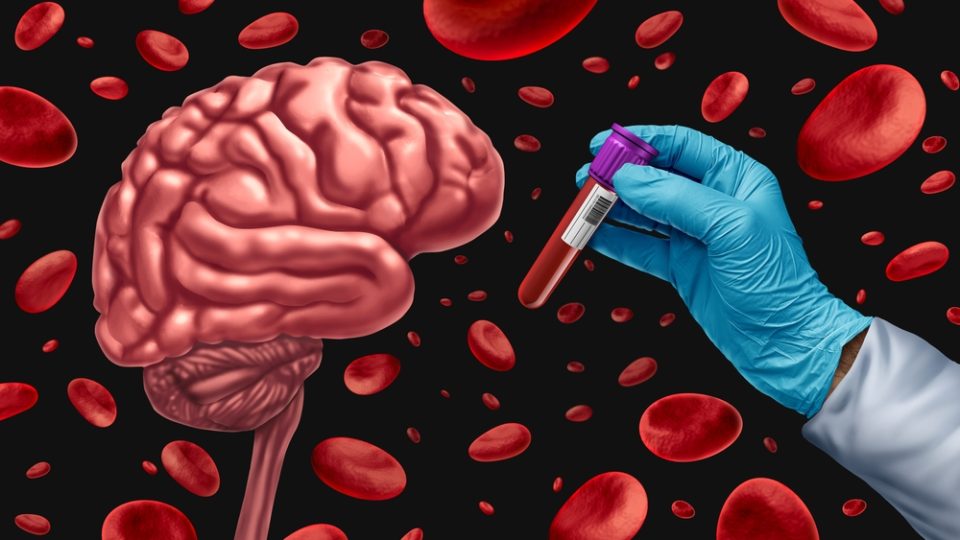 Fujirebio’s FDA-approved Alzheimer’s blood test hailed as ‘game changer’
