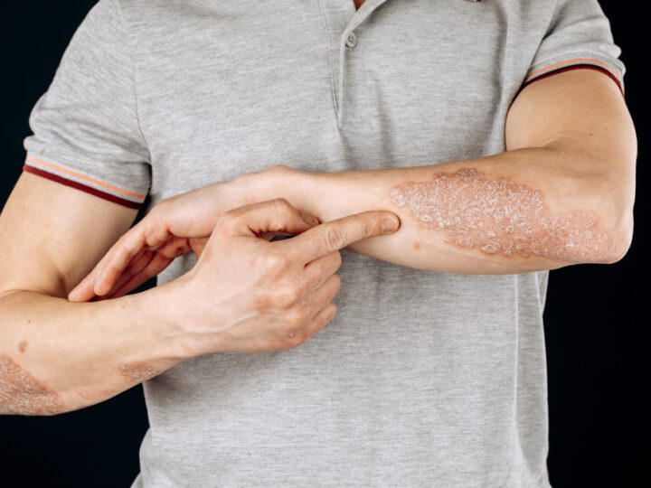 Man wearing a grey polo shirt pointing to a large patch of psoriasis on his forearm, with additional visible psoriasis plaques on his other arm. The skin appears dry, red, and scaly.