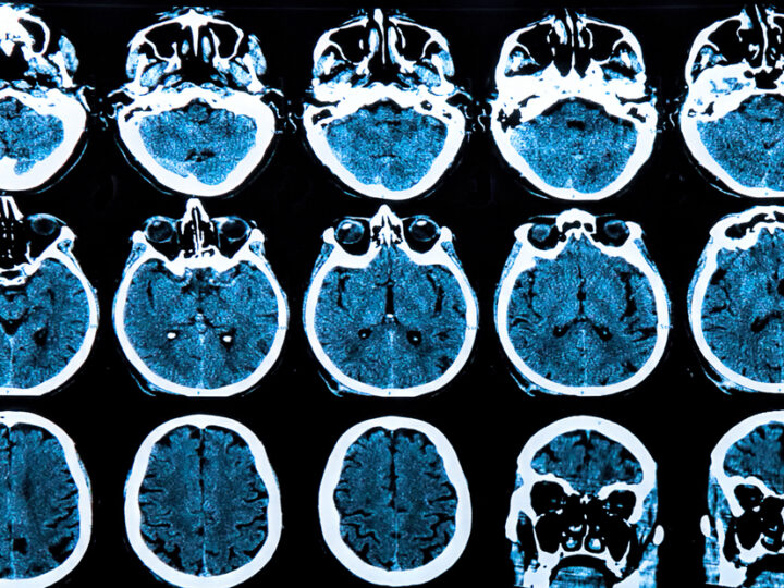 Multiple cross-sectional CT scan images of a human brain arranged in a grid, showing horizontal and coronal views in blue and white tones for diagnostic analysis.