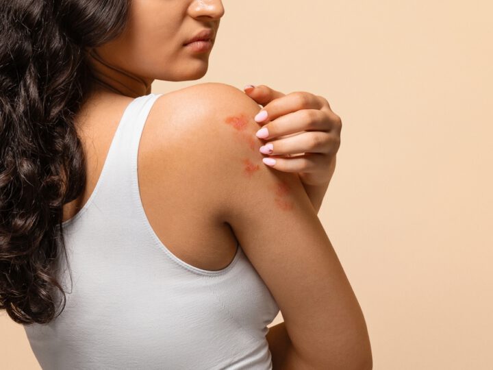 The Global Burden of Atopic Dermatitis: What the Numbers Reveal