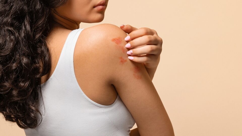 The Global Burden of Atopic Dermatitis: What the Numbers Reveal