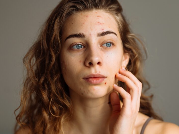 Young woman with acne