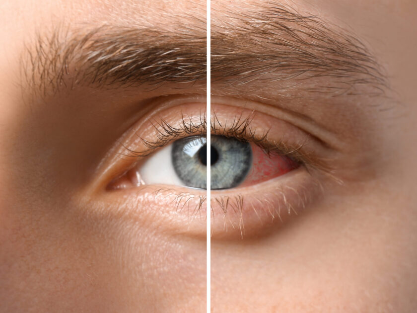 Young,Man,Without,And,With,Eye,Redness,,Closeup