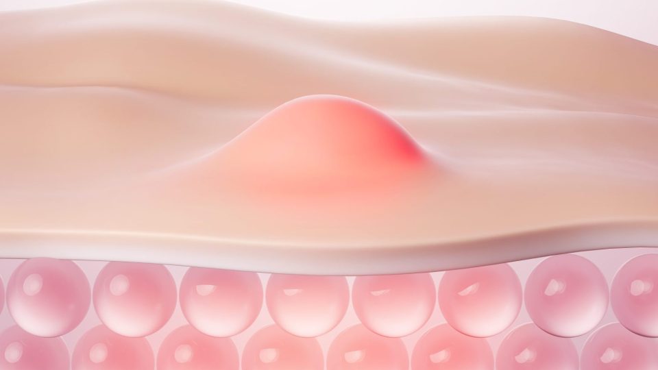 Acne’s Toll on Self-Esteem